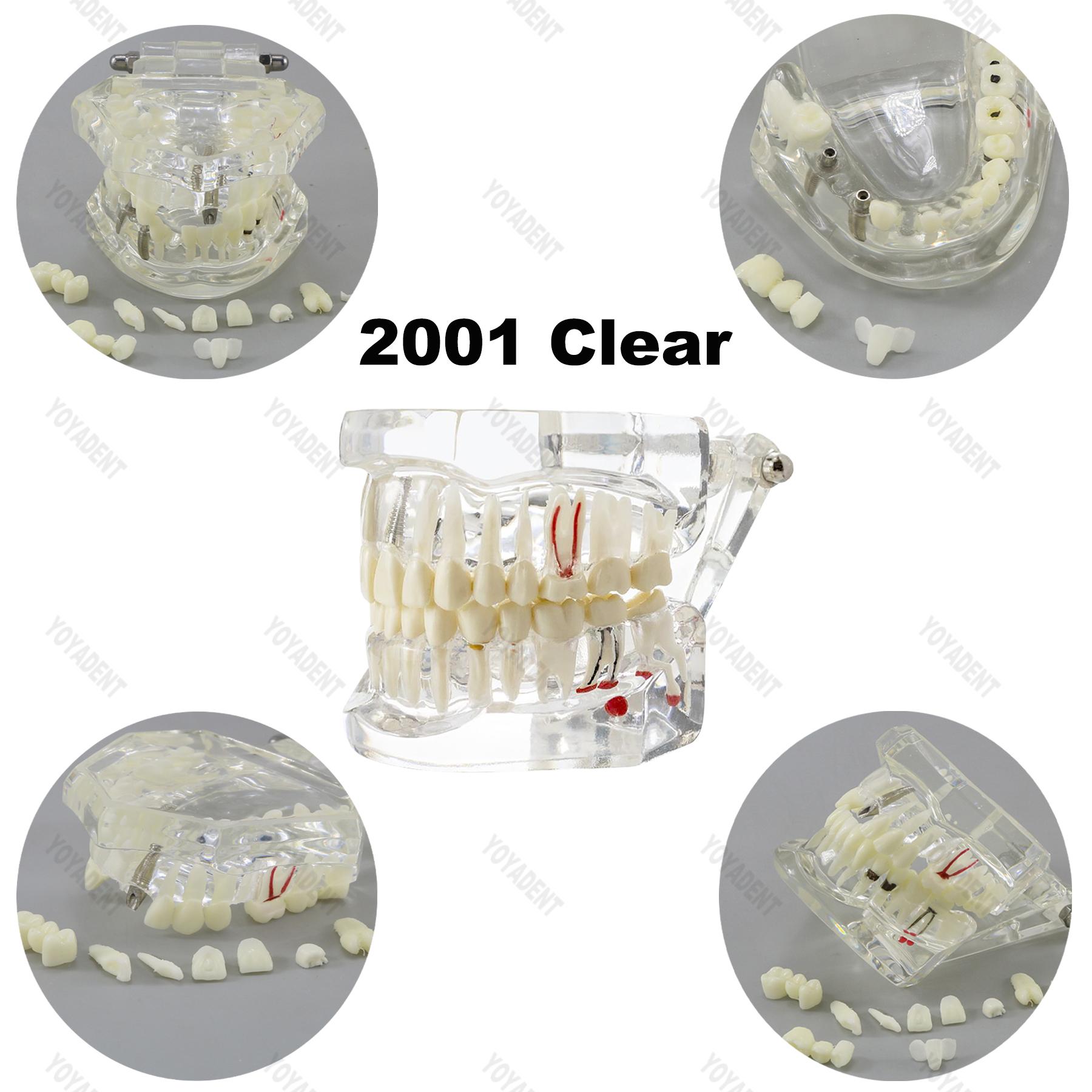 1 шт. Зубная модель Зубы Модель из смолы С реставрацией Мост Обучающие зубы Ремонт зубов Подходит Стоматология Обучение болезням Обучение