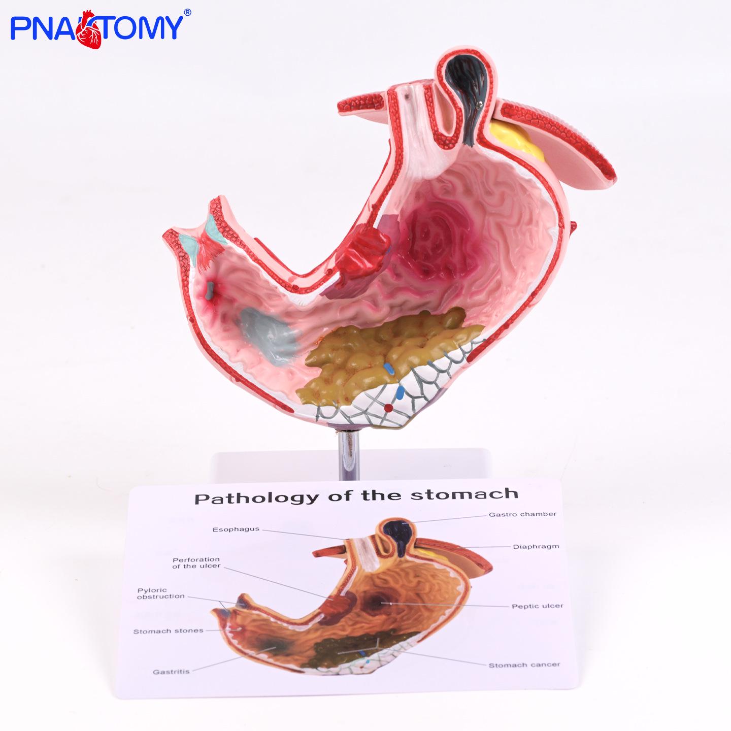 Pathological Stomach Anatomy Model for Gastroenterology Education PNT-0726