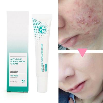 pimple pores removal cream
