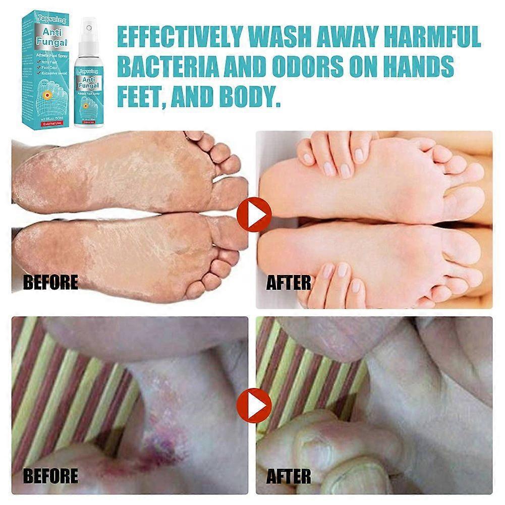 Athlete's Foot Cream for Fast Itch Relief & Fungus Treatment - Antifungal Ointment for Foot Odor, Sweat & Hong Kong Foot - 30g