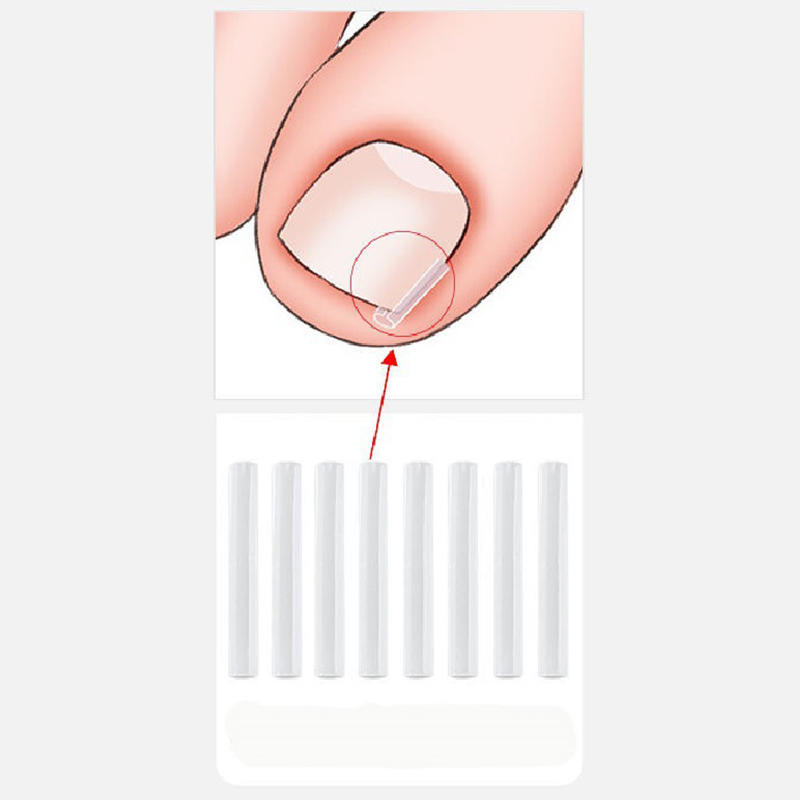 50PCS Ingrown Toenail Corrector Pads Kit Toenail Orthosis Corrector Strips Brace for Women Men