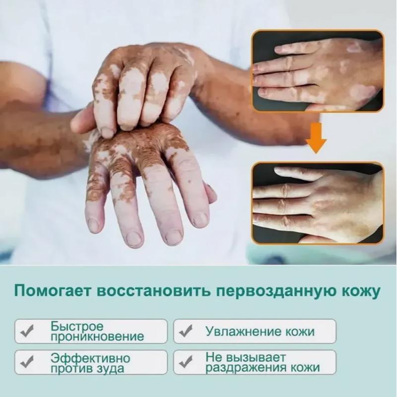 Vitiligo Relief Cream, Skin Care Cream, Vitiligo Cream, Improves Dryness, Suitable For All Skin Types