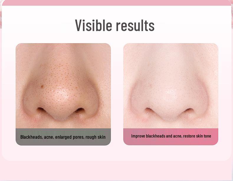 Ultrasonic Facial Cleanser & Blackhead Remover with EMS Ion Technology