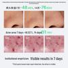 Hi!papa Teen Acne Control Skincare Set