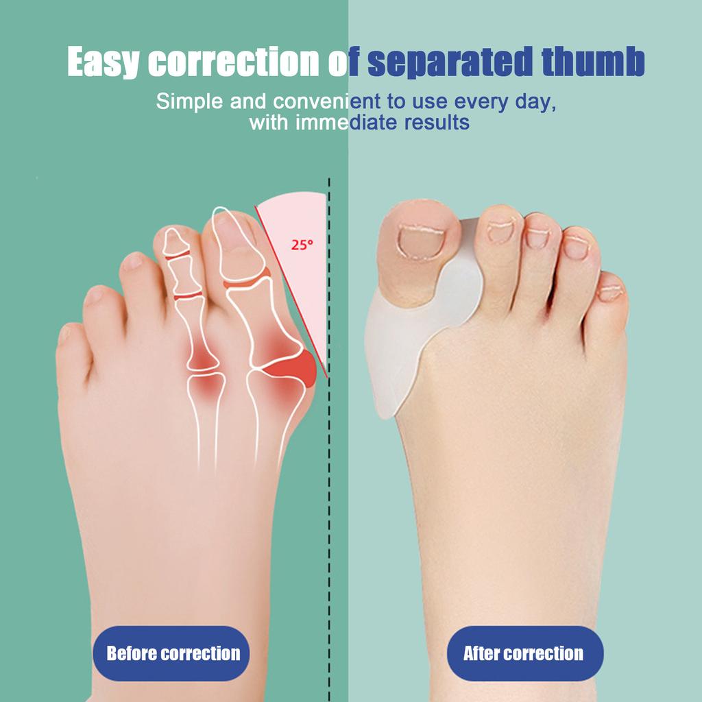 Zehenkorrektor, Silikon-Einlegesohle, Zehenabdeckung, Zehentrenner, Zehentrenner zur Korrektur von Daumenvalgus