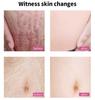 Pregnant Woman Stretch Mark Repair Cream Postpartum Repair and Fade Stretch Marks