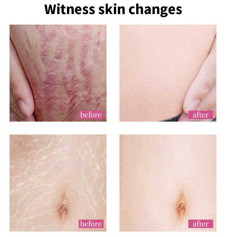 Pregnant Woman Stretch Mark Repair Cream Postpartum Repair and Fade Stretch Marks
