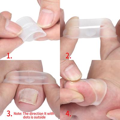 Silikónový nástroj na korekciu zarastených nechtov na nohách Neviditeľné ošetrenie zarastených nechtov