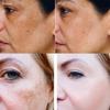 Powerful Spot-Removing Whiten Cream Brighten Skin Fast Eliminates Melanin Pigmentation Melasma Dark Spots