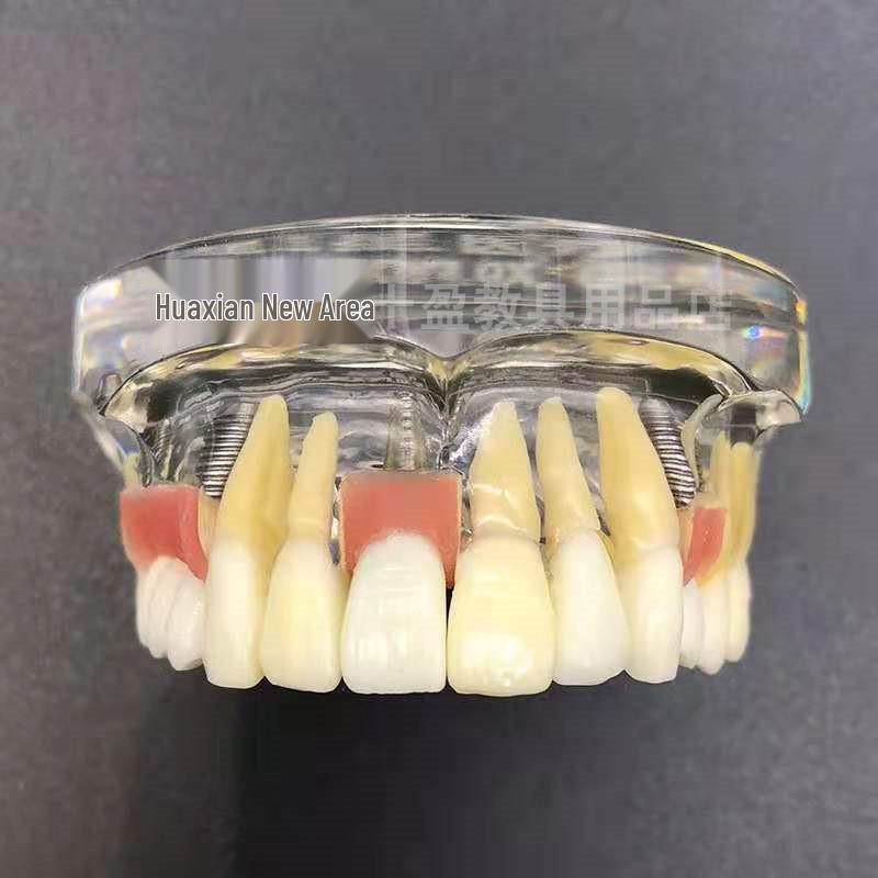 Modèle d'implant dentaire: Demi-bouche avec support, pilier, gencive molle, couronne, restauration de pont