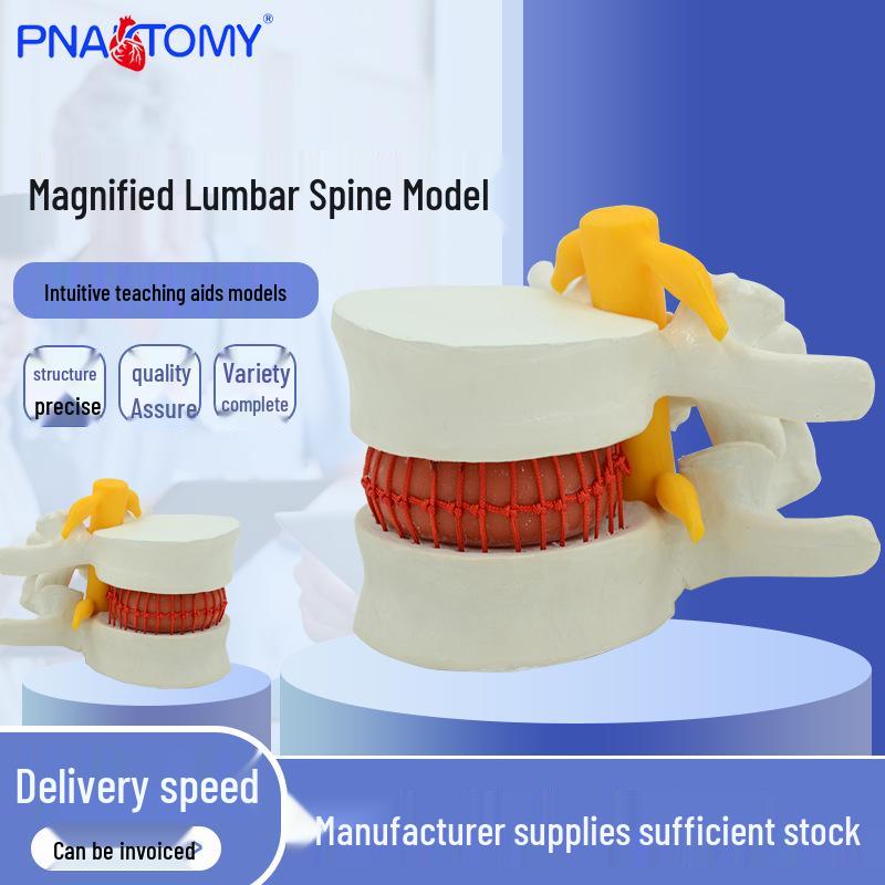Magnified Lumbar Disc Herniation Model for Orthopedic Teaching 12x12x10 cm