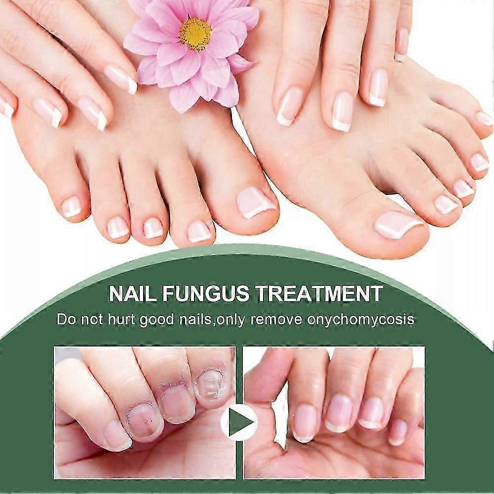 Extrem starke Nagelpilzbehandlung, beste Nagelreparatur Stoppt Pilzwachstum Effektiv