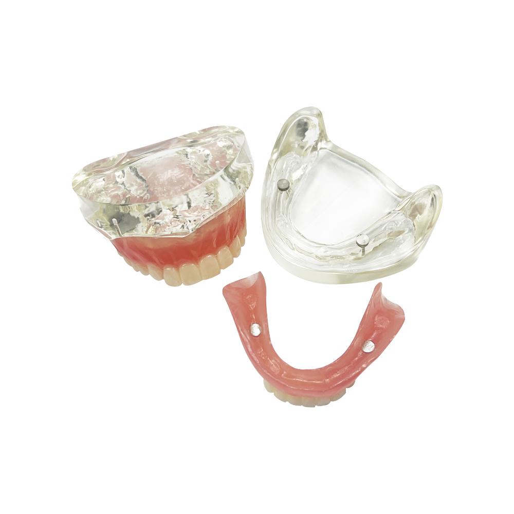 Modelo de Implante Dental 2 Implante Prótesis Completa Superior Inferior Modelo de Dientes Typodont Productos de Odontología Para Enseñanza Estudio