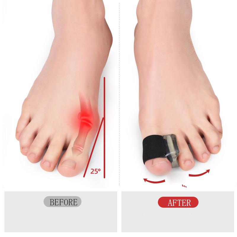 1Pair Big Bone Thumb Toe Separator Bunion Splint Straightener Corrector Foot Care Tools Hallux Valgus Protector Orthotics