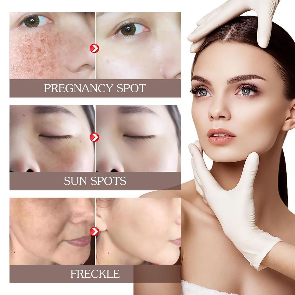 Spots Peel Off Facial Mask Freckle Pigmentation Removal Cream Chloasma Care Dark Spot Correction Glow Whiten Peeling Mask Strong