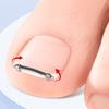 Narzędzie do Pedicure na Wrastające Paznokcie u Stóp Wkładka Pielęgnacja Paznokci u Stóp Prostowanie Korekcyjne Klips Zakrzywiony Zacisk Narzędzie do Korekcji Paznokci u Stóp