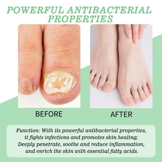 1/2Pcs 20ML Nail Fungus Treatment Gel Natural Ingredients Portable Men Women Hydrating Moisturizing Multi-Purpose