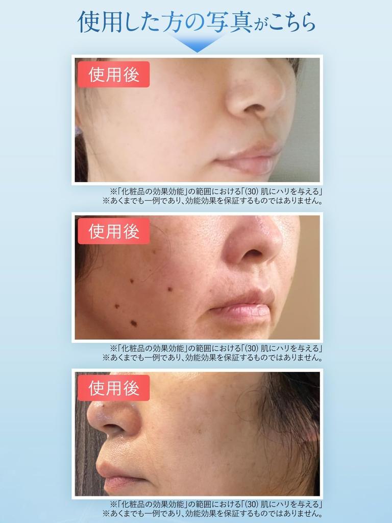 Nasolabial Refist Kita No Kaiteki Kobo Hyaluronic Acid Patch Needle Patch Refill [For Folds]