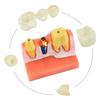 Dental Teach 4 Times Implant Analysis Crown Bridge Removable Model Dental Demonstration Teeth Model Dentisty Lab Material