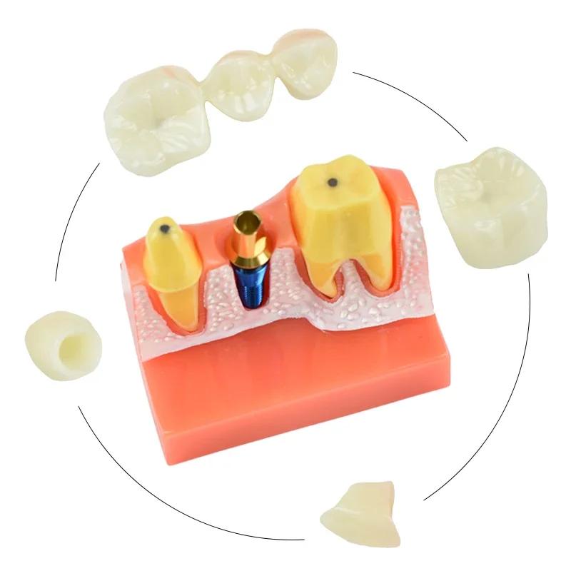Dental Teach 4 Times Implant Analysis Crown Bridge Removable Model Dental Demonstration Teeth Model Dentisty Lab Material