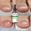 7DAYS Repair Nail Fungus Treatments Essence Foot Care Serum Toe Nails Fungal Removal Gel Anti-Infection