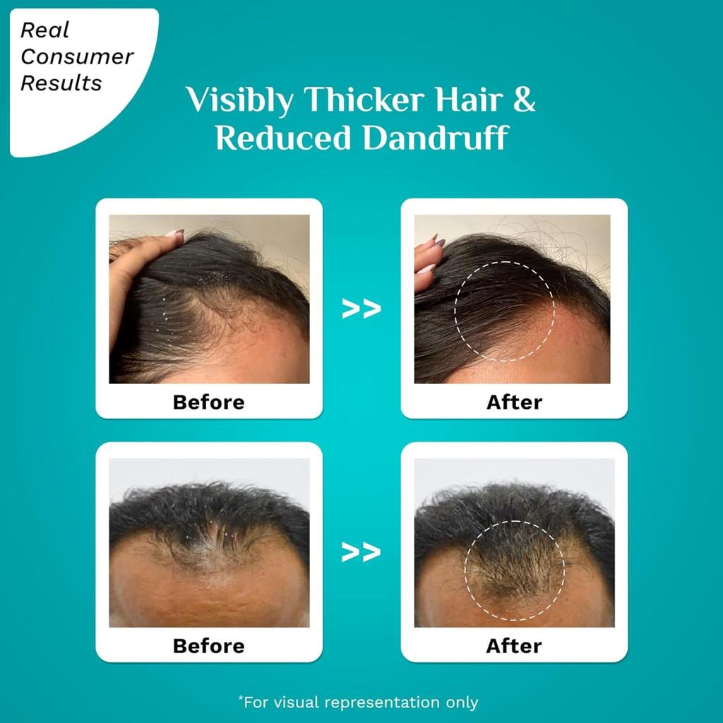 Pilgrim 3% Redensyl 4% Anagain Advanced Hair Growth Serum 30 ml For Flake-Prone Scalp Hair Density Care Support