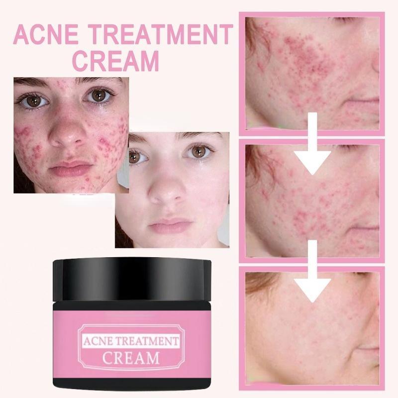 Remove Acne Mild Repair Acne Pits Acne Marks Nourishing Moisturizing Hydrating Acne Cream