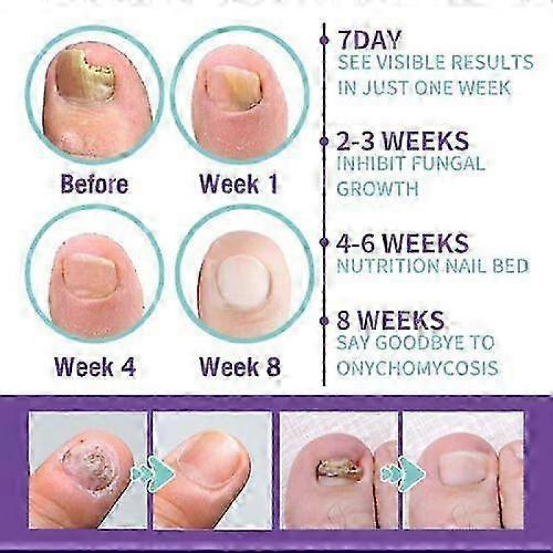 Medinail Fungus Spray,Toenail Fungus Treatment,Nail Fungus Treatment For Toenail