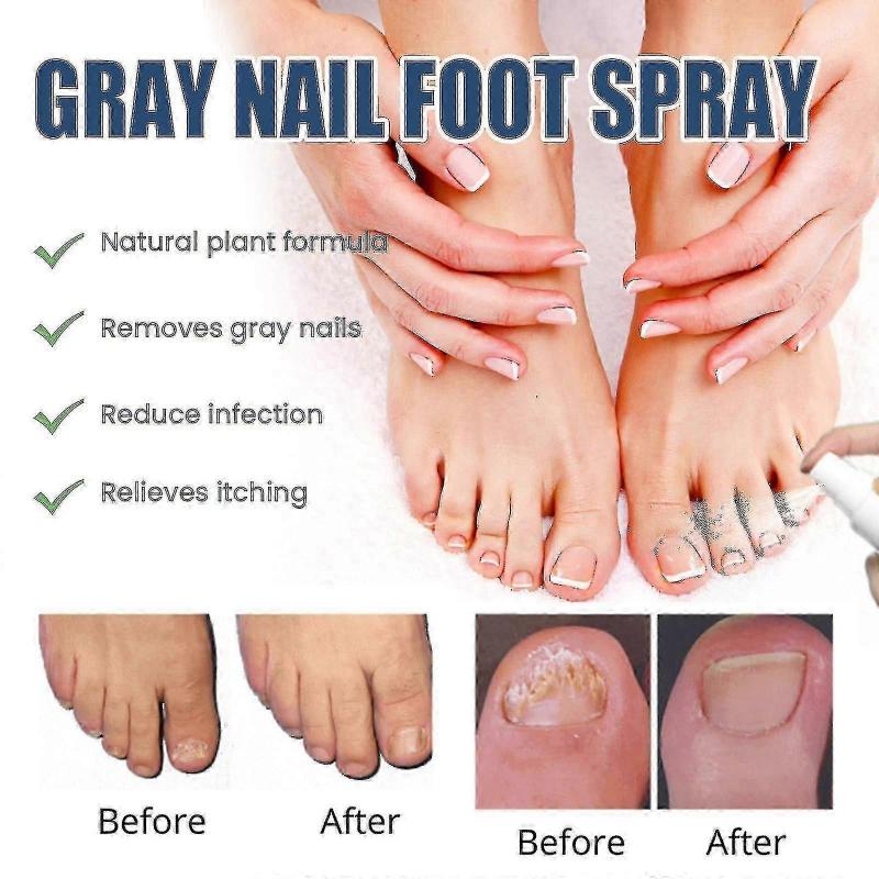 South Moon Onychomycosis Repair Spray Moisturizes and Cleans Odor Onychomycosis Soft Nail Dry Na