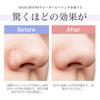 MAXGROOM Facial Massager: Water Peeling, EMS, Ultrasonic Peeling, Red/Blue Light Therapy, Pore Care, Pore Cleansing, IPX7 Waterproof, Compact, Automat