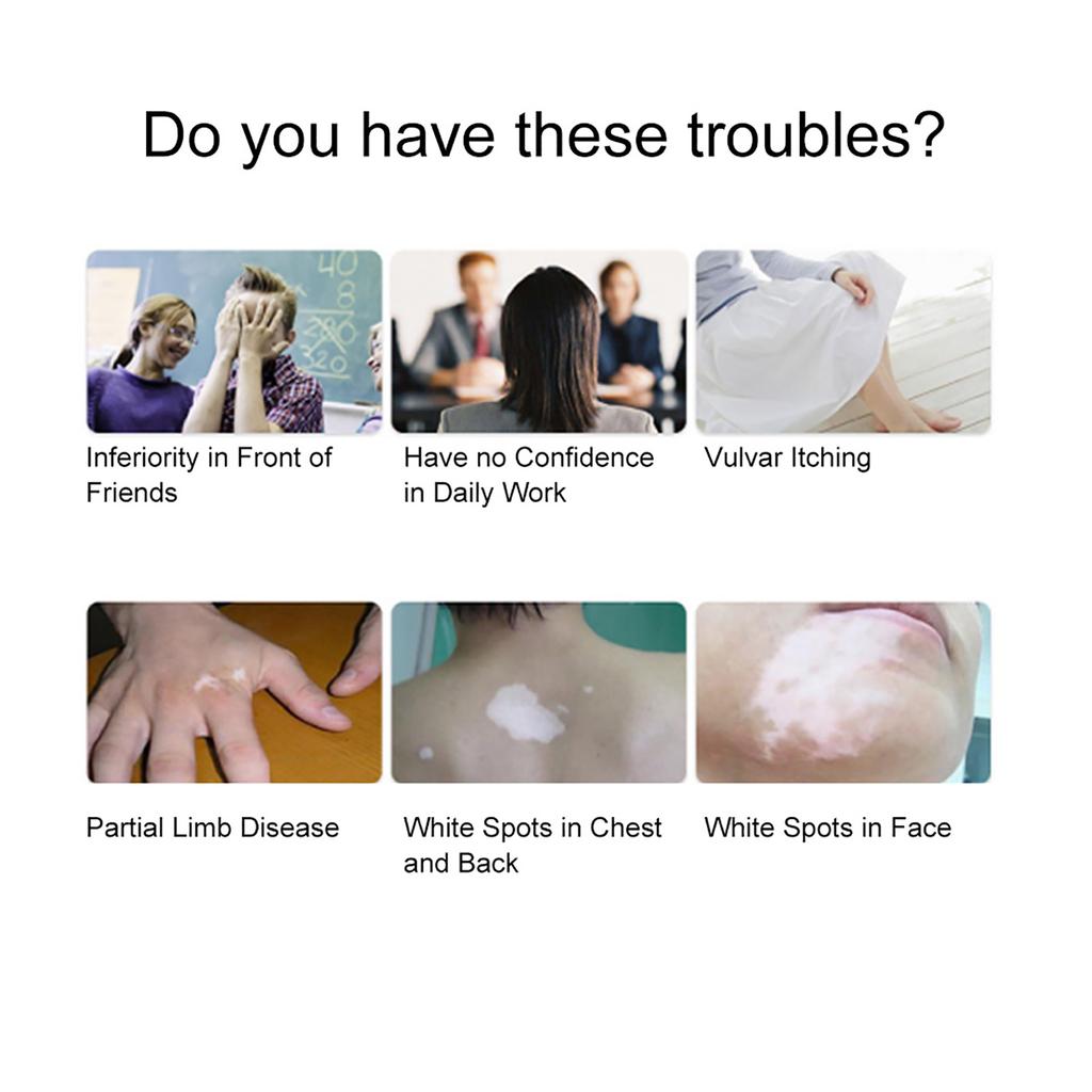 Vitiligo Treatment Liquid Repair White Spot Patches Liquid Vitiligo Cure Essence Skin Care