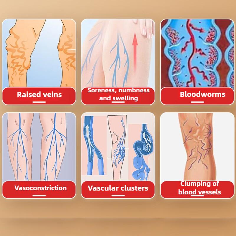 Special Shu ointment for varicose veins to treat blood vessel blockage and dredge in the legs