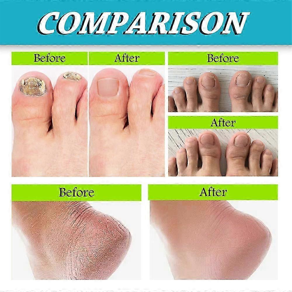 3pcs Foot And Spary, And Ful Foot Care-Min