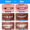 Moldable Tooth Replacements Kit For Fixing,dental Care Kit Tooth Repair Kit