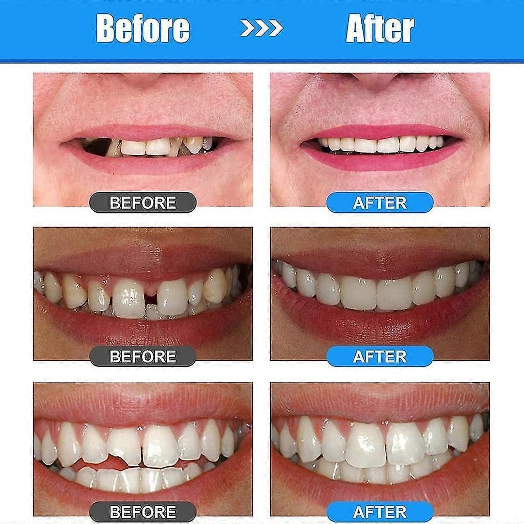 Moldable Tooth Replacements Kit For Fixing,dental Care Kit Tooth Repair Kit