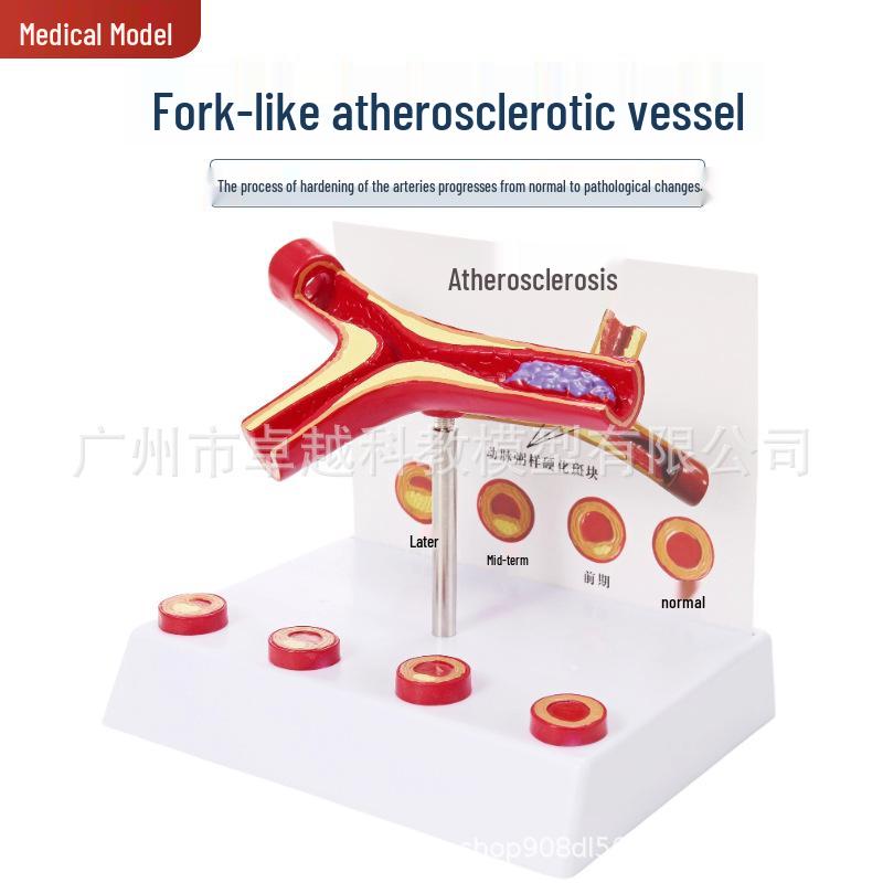 Elderly Heart Atherosclerosis & Thrombus Model