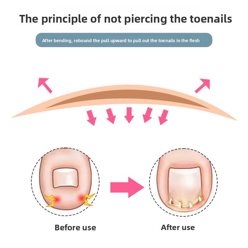 Nowy Pozytywny Klamra na Paznokcie Palec U Stopy Naklejka Ustalająca Rowek Paznokcia Zakręcony Paznokieć Inkrustowany Paznokieć Fizycznie Regulowany Rozciągliwy Demontaż Dostępny dla Mężczyzn i Kobiet