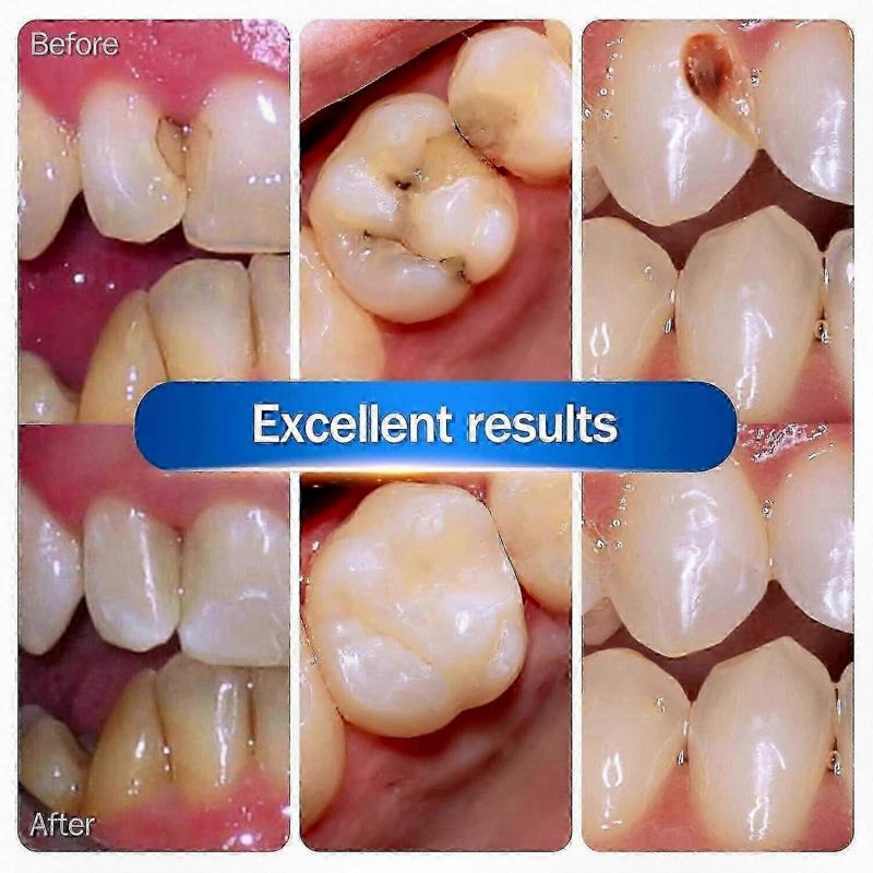 Starker Zahnzement zur Zahnreparatur, Kariesfüllung & Restauration, Harz-Zahnreparaturset für die dentale Restauration