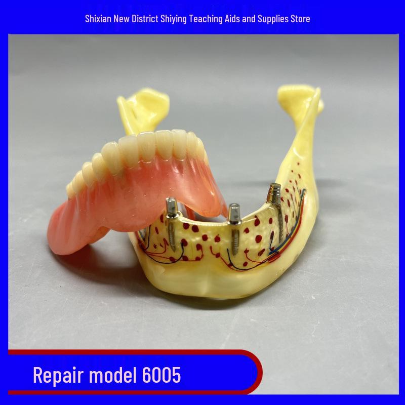 Transparent Mandible Bone Model with Implantation Screw for Denture Restoration 6005