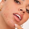 360Pcs Invisible Pimple Removal Anti-Acne Hydrocolloid Patches Spots Marks Concealer Beauty Makeup Tool Repair Sticker