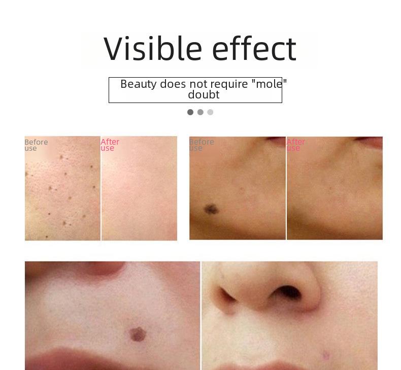 Stiftset zur Muttermalentfernung mit 12 Geschwindigkeiten: Gerät zur Muttermalentfernung, schwarzer Muttermalradierer, Augenbrauenreiniger, Reparaturcreme, spurloser Schönheitsstift.