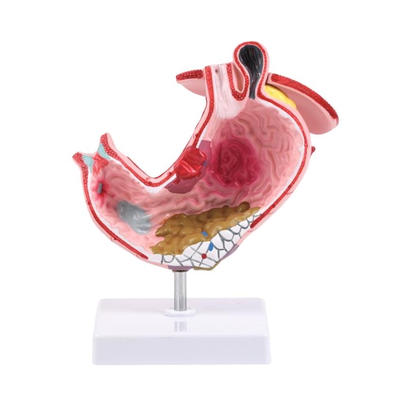 

Модель больного желудка Модель анатомии желудка Патологическая модель желудка Для студентов-медиков и обучения здравоохранению 1