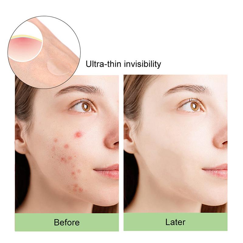Acne Patch Facial Repair Acne Clean Pores Moisturize And Smooth Skin Acne Patch Facial Stickers Skin Care Tools