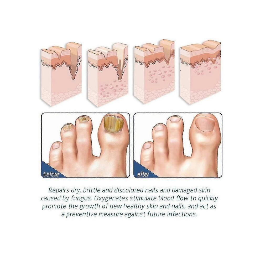 (4PCS)1-10xOnycostop Pro Foot and Nail Spary Foot Odor Treatment Spray Nail Growth Ser