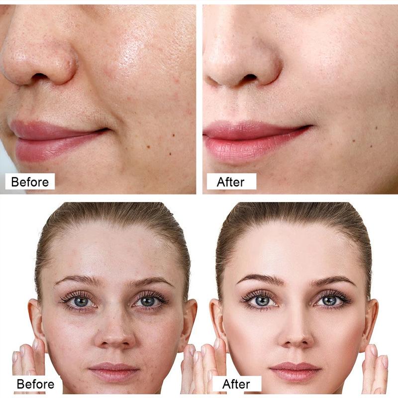 Needle Serum Anti-Aging Face Micro-Needle Ampoule for Firming & Hydrating MICROLIFT SYSTEM