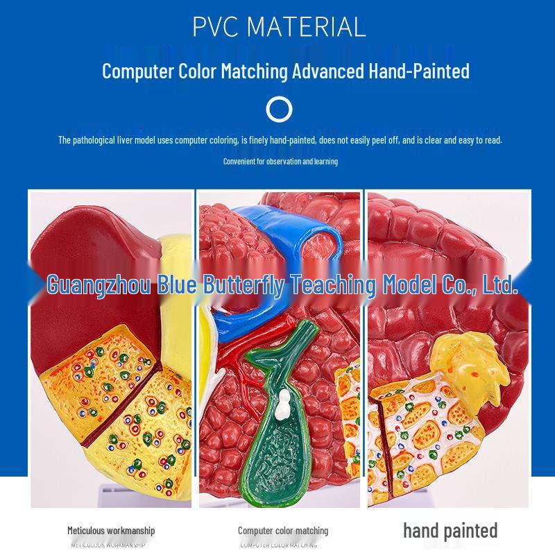 Clinical Pathology of Liver Models: Sclerosing Cholangitis & Fatty Hepatitis for Doctor-Patient Communication