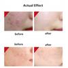 Azelaic Acid Acne Gel Cream 20g Oil Control Repair Dark Spot Fade Gentle Face Care