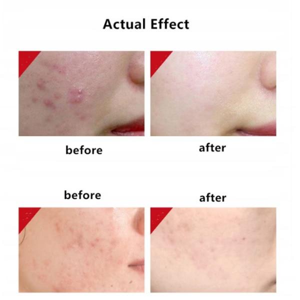 Azelaic Acid Acne Gel Cream 20g Oil Control Repair Dark Spot Fade Gentle Face Care