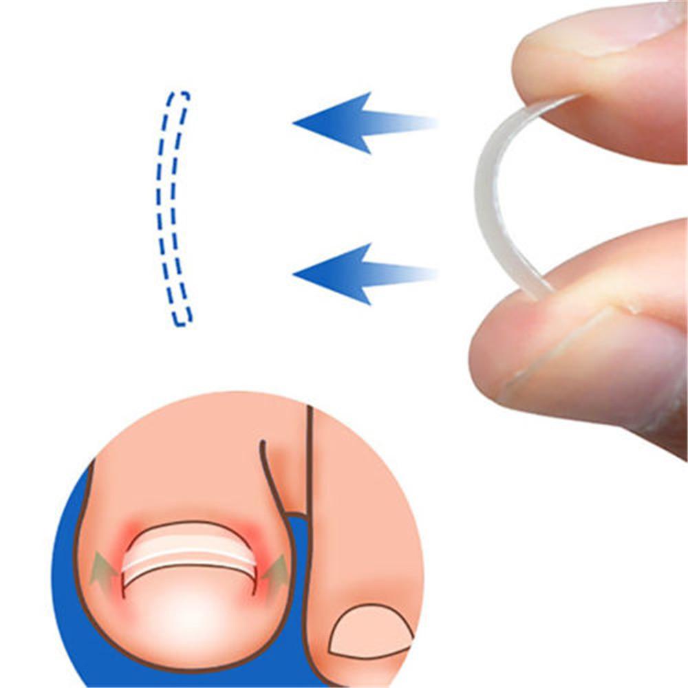 Маникюр для ног, здоровье ног, уход за ногтями, коррекция вросших ногтей, пласты