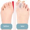 1 Pair Toe Spacers Bunions Corrector Toe Separators for Women and Men Big Toe Straightener Foot Toe Spreader